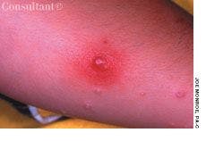 Molluscum Contagiosum: Papule Turned Pustule on the Leg of a Young Boy