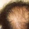 Androgenetic Alopecia in Women