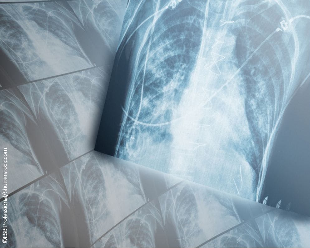 A Pro-Con Debate on How to Care for Patients With Interstitial Lung Disease