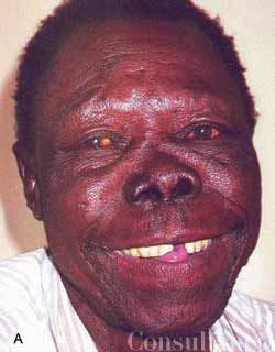 Leprosy (Hansen Disease)