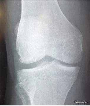 Lateral plateau fracture after hyperextension 