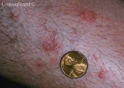 Nummular Eczema: Don't Mistake it for a Fungal Infection  