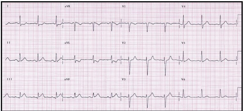Subtle ST-Segment Elevation in Inferior Leads: Is This an Infarction?