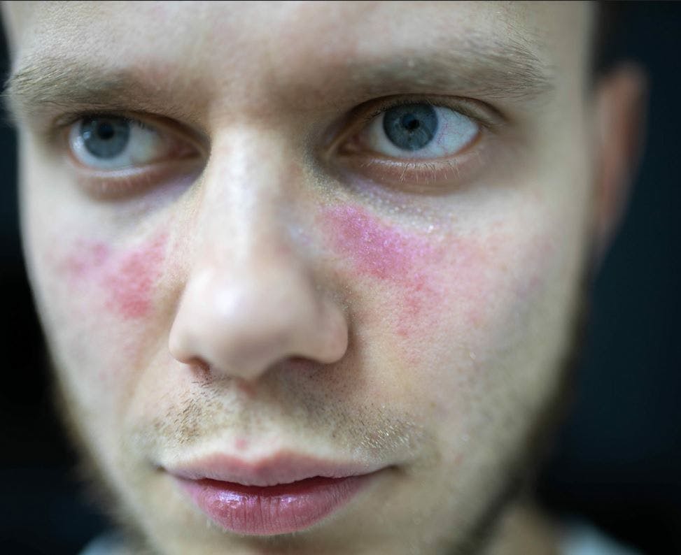 Atlantic Health System Tests Novel CAR-T Cell Therapy for Lupus in First US Patient / image credit lupus on a young man ©velimir/stock.adobe.com