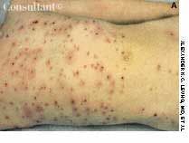 Chickenpox and Its Complications