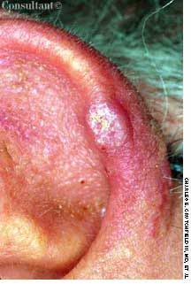 Chondrodermatitis Nodularis Helicis in a 61-Year-Old Man