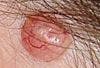 Basal Cell Carcinoma at a Site Not Exposed to Sun