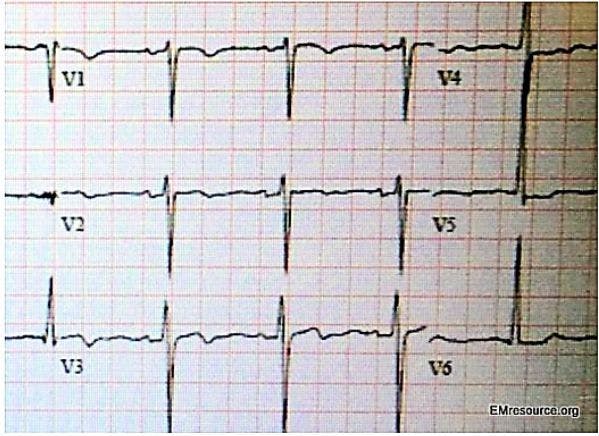 ECG Challenge: Severe Episodic Chest Pain in a 31-year-old Woman