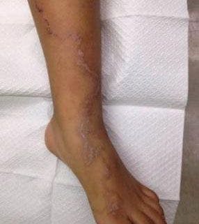 A Migrating Lesion After a Walk on the Beach: Your Dx?
