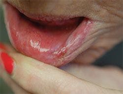 Case 1: Is this long-standing oral lesion malignant?