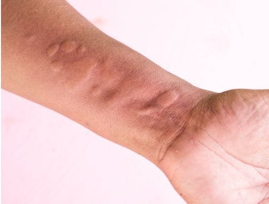 Tezepelumab Treatment Leads to Sustained Reductions in CSU Disease Activity, Inflammatory Markers / image credit hives; ©chomplearn/stock.adobe.com