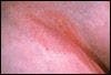 How do you explain this chronic, malodorous rash?