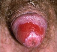 Should this penile rash prompt a search for other lesions?