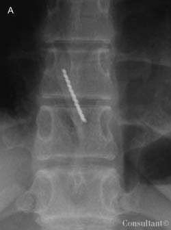 Swallowed Toothbrush in a Bulimic Adolescent