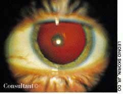 Posterior Subcapsular Cataract