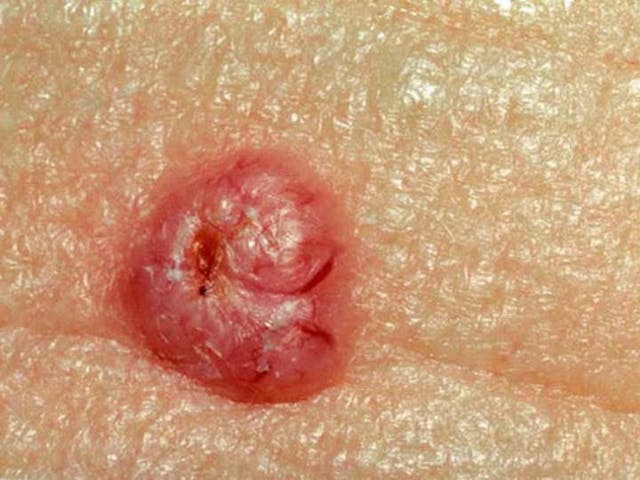 Basal cell carcinoma (Medpagetoday.com)