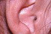 All Ears:  Auricular Seroma and Pyogenic Granuloma