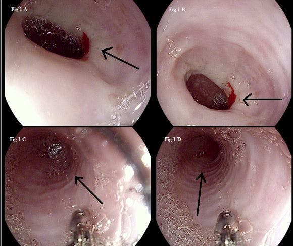 Trachealization of the Esophagus 