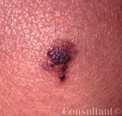 Long-standing Lymphangioma Circumscriptum on a Woman's Knee