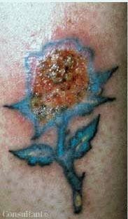 Infected Tattoo in a Patient With Diabetes