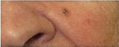 Three Suspicious Lesions on an Elderly Woman's Face 