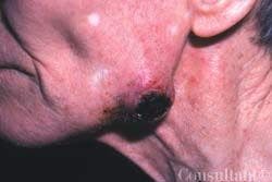 Painful Squamous Cell Carcinoma on Jaw