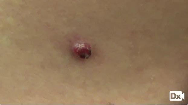 A Friable Lesion on the Neck of a 15-year-old Boy: Dx?