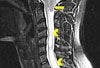 Chiari I Malformation in a Young Man With Persistent Neck Pain