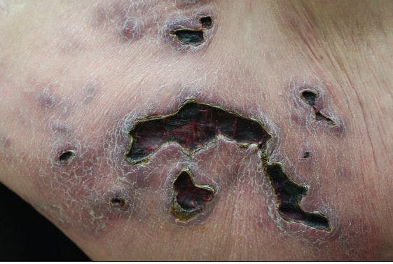 How do you explain this ulcerative abdominal rash?