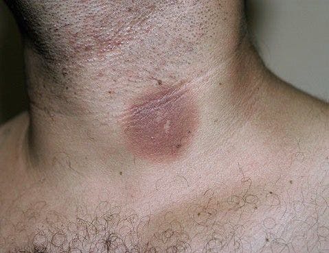 Round Red Patch on a Man's Neck