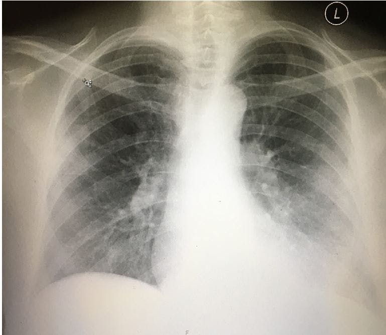 Fever and Headache, then Cough, in a 52-year-old Woman 