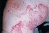 What caused this highly pruritic rash that resists OTC remedies?