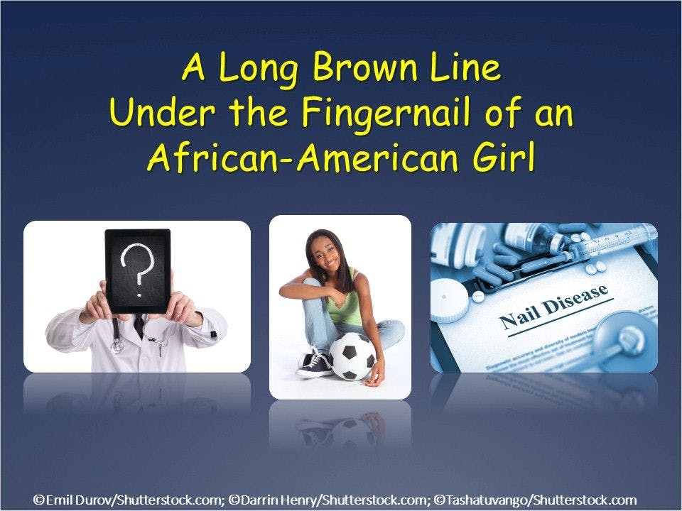 A Long Brown Line Under A Young Woman's Fingernail 