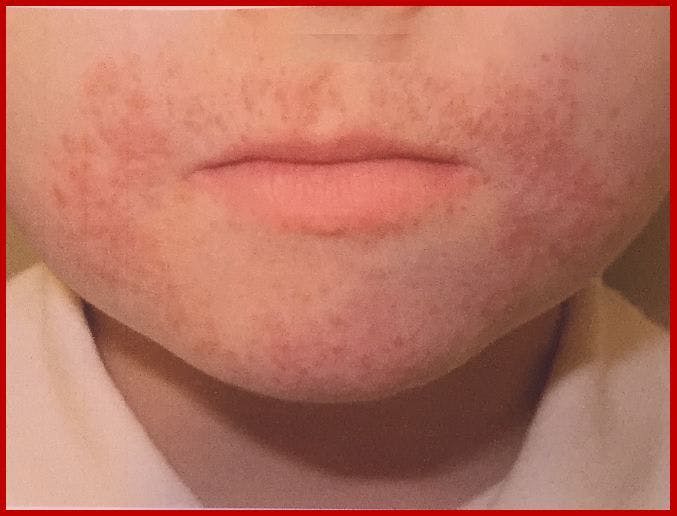 Rash Around the Mouth of a 5-year-old Child
