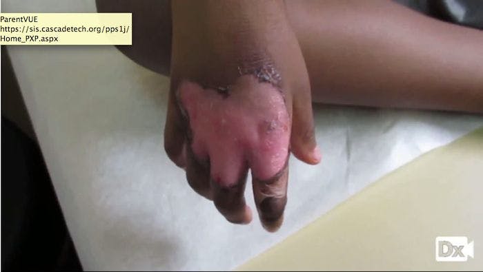 A 5-year-old with a Hand Burn 