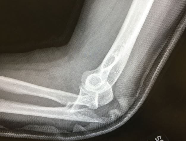 Seen in the ED: Name this Elbow Injury 
