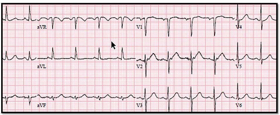 ECG Challenge: Neck Pain and a Mystery Fall 