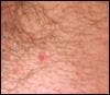 Molluscum Contagiosum After First Sexual Contact 
