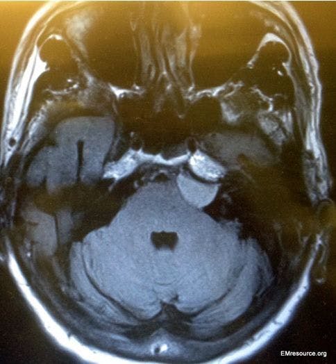 Cerebello-pontine angle tumor in a 68-year-old man 