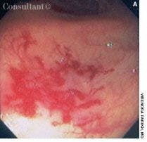 Colonic Arteriovenous Malformations in Man With Family History of Colorectal Cancer