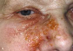 Herpes Zoster and Molluscum Contagiosum