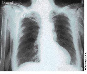 Histoplasmosis-Induced Lung Calcification