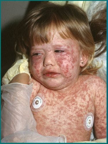 Measles Quiz: Can You Spot the Symptoms?