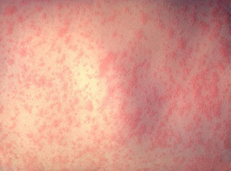 Measles Weasles Its Way Back