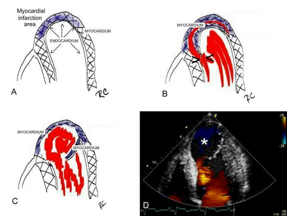 Sequence of events after acute MI that lead to the loss of left ventricular wall