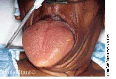 Anaphylaxis Presenting as Macroglossia
