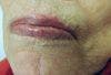 Basal Cell Carcinoma on Lip of an 86-Year-Old Woman