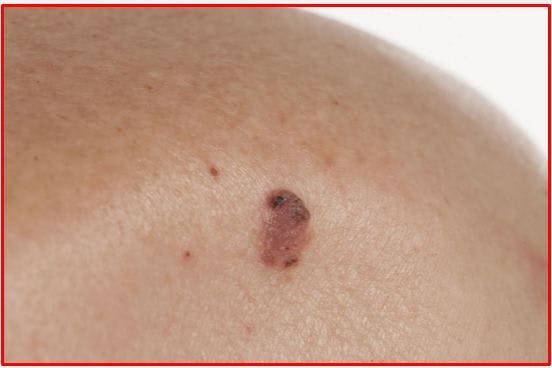 Actinic Keratosis and Squamous Cell Carcinoma: Photodamage in Progress 