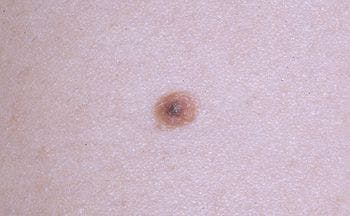 Atypical nevus