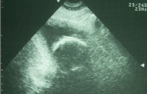 Calcified Foley Balloon Causing Urinary Retention 